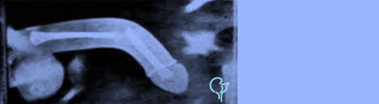 Incurvación del pene